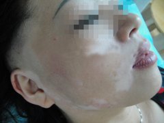 面部白癜风该怎样治疗？