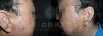 男性面部散发型白癜风1年